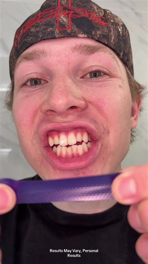 Achieve Whiter Teeth with Whitening Strips
