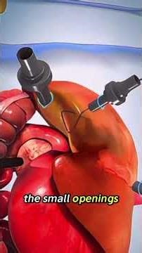 Gallbladder Removal Surgery Explained | Step-by-Step