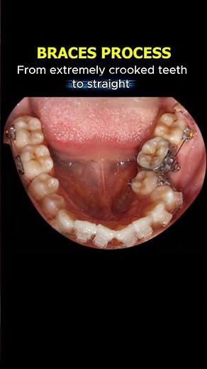 Braces process: From extremely crooked teeth to straight #braces #orthodontics #teeth