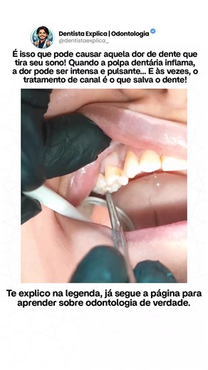 CRÉDITOS: @dr.layth_khaled Conteúdo original do perfil. Material compartilhado exclusivamente para fins educativos. Não reivindicamos a autoria do conteúdo. Tratamento de canal: o que acontece dentro do dente? No interior do dente existe a polpa dentária, um tecido que contém nervos e vasos sanguíneos. Quando ela sofre uma inflamação irreversível ou necrose, pode ser necessário realizar o tratamento endodôntico. O procedimento envolve o acesso à câmara pulpar, a remoção do tecido comprometido qu