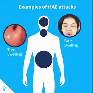 1M views · 1.3K reactions | The symptoms of hereditary angioedema (HAE) can include attacks of swelling that can happen anywhere in the body. Some people experience a tingling sensation or a rash before an attack. Learn more about how an HAE attack occurs. | DiscoverHAE | Facebook