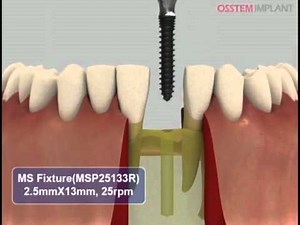 HIOSSEN OSSTEM HM / MS System mini denture or narrow bridge implant