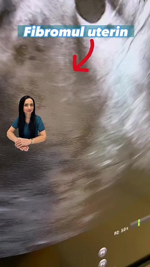 152K views · 441 reactions | Fibromul uterin reprezintă o patologie...