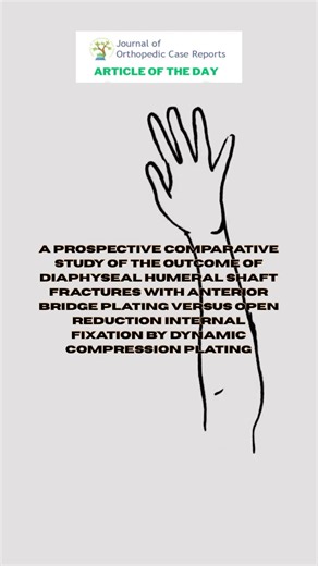 Humeral shaft fractures: bridge plating vs dynamic compression plating