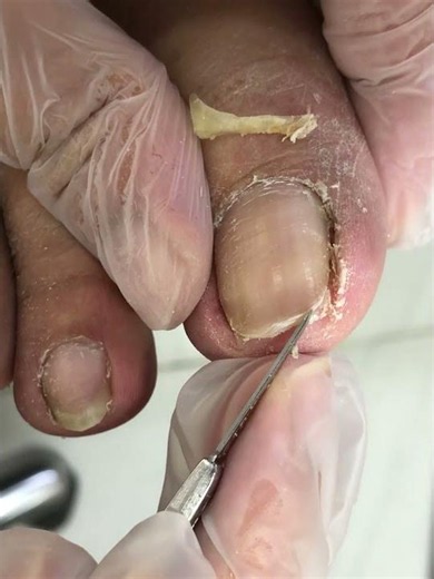 Ingrown nails connect to black grime, clean #nails #satisfying #pedicure