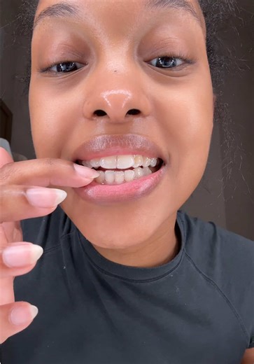 Change My Invisalign with Me: Tray 5 Journey
