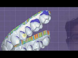 Plovdiv 2.4 Snap on Smile Tutorial first part