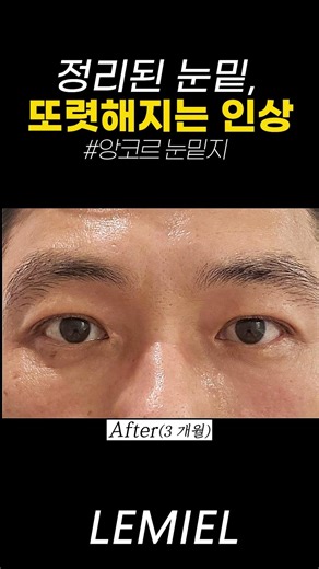앙코르 눈밑지 리얼 후기 l 르미엘성형외과