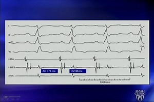 🫀 Understanding Heart Blocks & Arrhythmias on EPS Tracings Dive into the world of cardiac electrophysiology! Learn how to interpret EPS tracings, recognize different heart blocks, and identify arrhythmias. Perfect for medical students, cardiology trainees, and anyone passionate about heart health. #Cardiology #HeartBlocks #Arrhythmias #EPS #CardiovascularEducation #MedicalEducation #HeartHealth | Cardiovascular Education
