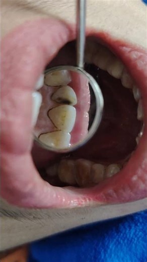 Tooth decay between teeth. Black spots on the teeth. Remember to get your teeth checked to avoid ...