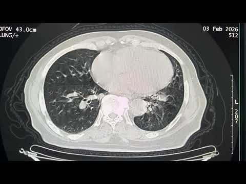 HRCT CHEST LUNG WINDOW DIAGNOSIS