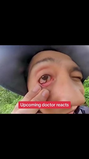 3.5K views · 13 reactions | Worm parasite in someones eye #parasite #parasiteremoval #eyeparasites #worm #medical #doctorreacts | Inside Anesthesia | Facebook