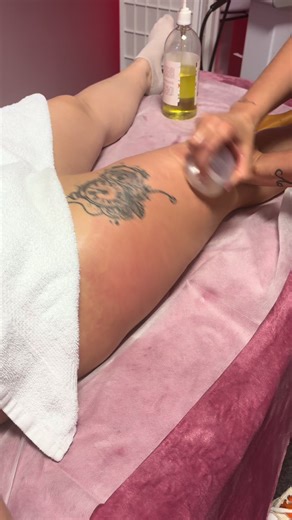 The Benefits of Cupping Therapy for Cellulite