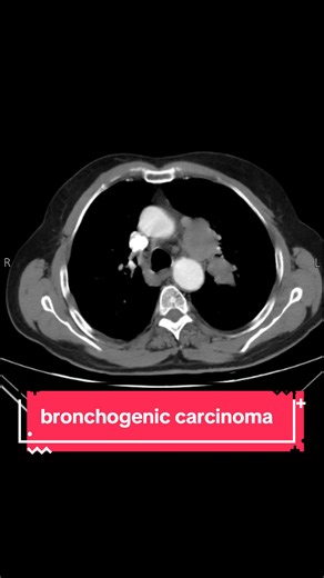Central left hilar mass with distal bronchocele in the apicoposterior segment of the left upper lobe, associated with pathologic mediastinal and hilar lymphadenopathy - findings are highly suggestive of bronchogenic carcinoma. #radiology #cases #ct #medicine