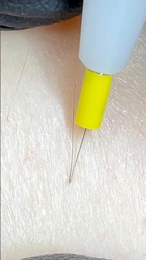 Les étapes d’une séance en thermolyse épilation électrique haute fréquence Apilus #electrolyse
