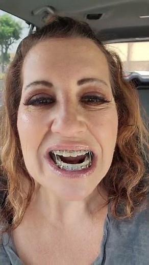 Adult Braces at 55. Update.
