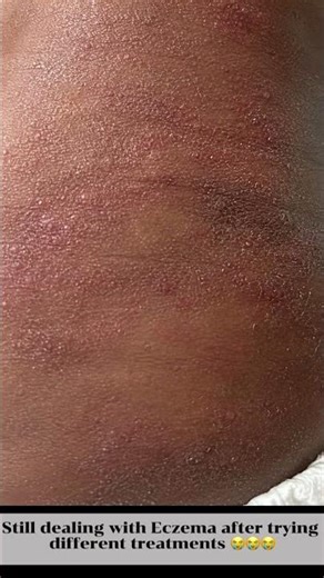 How to treat Eczema naturally