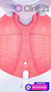 ✨ Feel confident. Feel empowered. ✨ Vaginal laxity is more common than you think — especially after childbirth or with age. But you don’t have to live with discomfort or decreased satisfaction. At Clinic21, we offer non-surgical, FDA-cleared vaginal tightening treatments that restore tone, function, and confidence — safely and effectively. Discussion with Dr. Tasnuva Bipasha. 💗 Reclaim your intimate wellness. 💡 No downtime. No surgery. Just real results. 📞 Book a private consultation today ‪ 