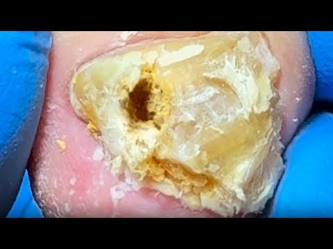 Toenails Are Like A Yellow Stone, Clean The Internal Impurities【Xue Yidao Pedicure】