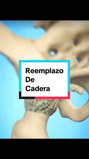Reemplazo de Cadera: Procedimiento Quirúrgico Explicado
