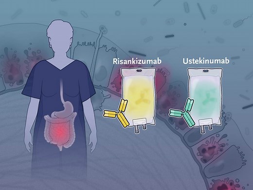 For patients with moderate-to-severe Crohn’s disease and an inadequate response to anti-TNF therapy or unacceptable side effects with such therapy, data from head-to-head trials of alternative biologic therapies are lacking. Research findings are summarized in a new Quick Take video. https://nej.md/46dtnFY | The New England Journal of Medicine