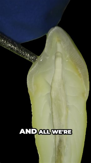 Mastering Root Canals with Ultrasonic Techniques