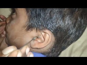 "Ultimate Deep Ear Cleaning ASMR — So Relaxing You’ll Melt
