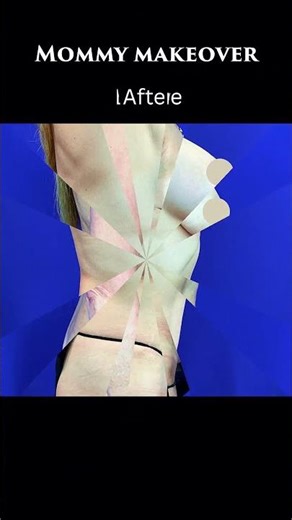 Mommy Makeover Before and After