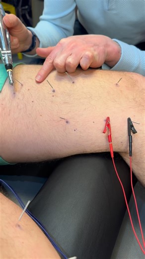 🏆 Dry needling uses a thin needle to target trigger points and release stubborn muscle tension. It’s ideal for chronic pain, nerve irritation, and mobility issues that stretching just won’t fix. Feel the relief and reset your body naturally. #DryNeedling #MuscleRecovery #TriggerPointRelief #ChiropracticCare #SportsPerformance #drkyleross | Dr_kyleross