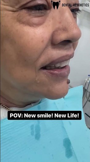 Amazing Smile Transformation with Veneers Before And After #dentalaesthetics