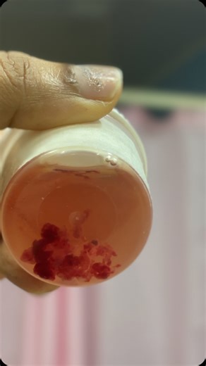 DrSinsilaa on Instagram: "Pipelle endometrial biopsy…make the diagnosis more easy and cost effective…#drsinsila #mariatheresahospital #abnormaluterinebleeding"