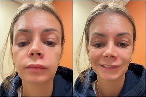 Se explotó un granito en la cara y quedó paralizada: qué es el “Triángulo de la muerte” en el rostro, según una dermatóloga