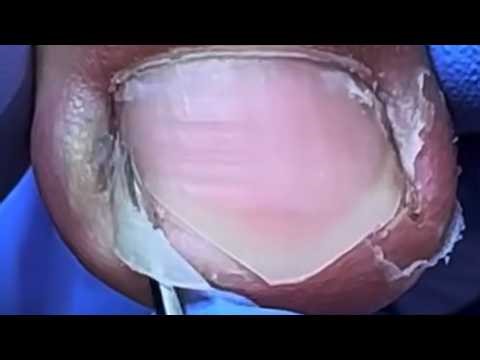 There is so much pus from pulling the nails up, it's crazy!【Dr. Liu's Pedicur】