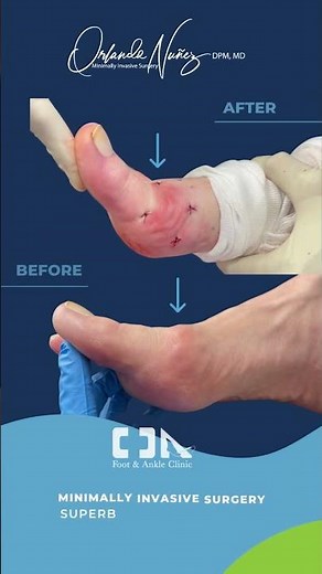 Hallux Rigidus (Osteoarthritis bigtoe joint) - Minimally Invasive Surgery (MIS) Correction