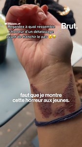 On connaît tous quelqu'un qui a un tatouage gênant et qui regrette de l'avoir fait… La bonne nouvelle, c'est qu'on peut s'en débarrasser. Mais au fait, ça marche comment le détatouage ? Et qu'est-ce qu'on risque ? | Brut
