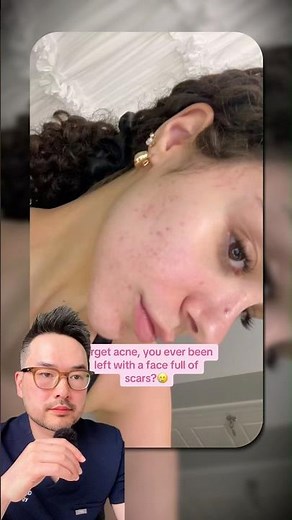 How to treat acne scars #Dermatologist #Skincare #AcneScars