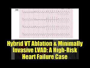 Hybrid VT Ablation & Minimally Invasive LVAD: A High-Risk Heart Failure Case