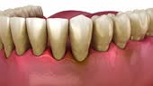Gum recession process. Medically accurate 3D animation