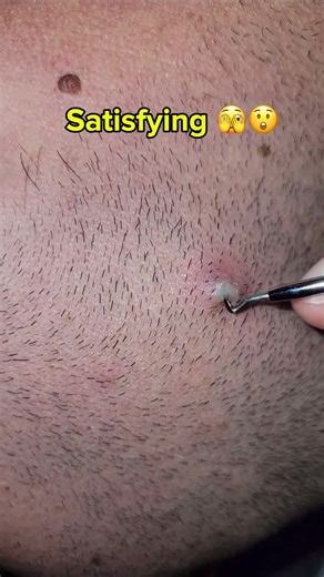 Oddly satisfying ingrown hair removal #skincare #beauty #acne #satisfying #skin #ingrownhair
