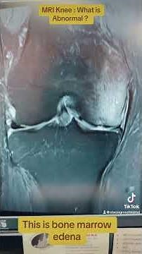 MRI Knee : What is Wrong ?