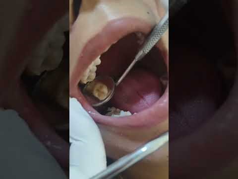 Composite filling in maxillary molar# deep filing maxillary molar# composite restoration procedure