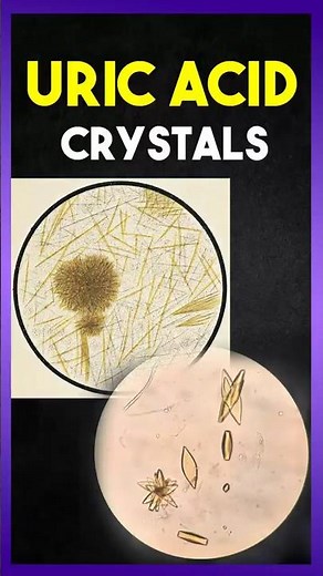 What are " Uric Acid Crystals " ?