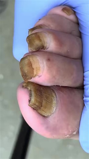 11K views · 96 reactions | What’s hiding under this toenail will shock you A926 Beautiful moments of care and relaxation through a gentle pedicure experience. Simple, clean, and satisfying. ✨ Disclaimer: This video is for educational and relaxation purposes only. All content belongs to the respective owners, no copyright infringement is intended. | Dandruff ASMR | Facebook