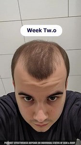 Hair fall? Thin patches? Slow growth? 😔 FEG Hair Growth Serum strengthens roots, reduces hair fall, and boosts new hair growth. 🌱 Made with natural ingredients — no side effects, no chemicals. Get thicker, fuller hair in just weeks! | Makeup Valley