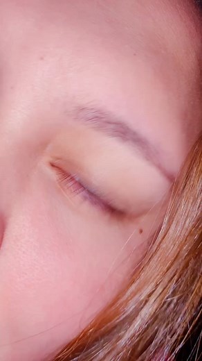 After Lasik Bruising. #eye #fyp #lasik #foryoupagе