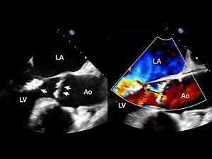 Aortic and Mitral Valve Endocarditis Due to Austin Flint Phenomenon