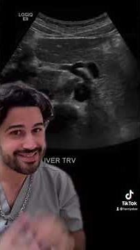 Seagull Sign (Celiac Artery and Branches)