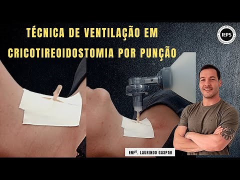 Cricotireoidostomia por Punção. Técnica para Ventilação.