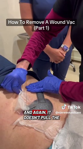 How to Safely Remove a Wound Vac: Step-by-Step Guide