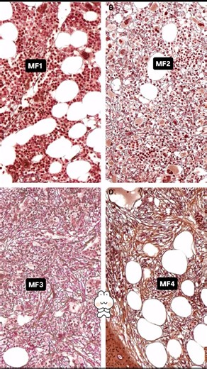 The Patho Pinks on Instagram: "Reticulin Grading in Bone Marrow: Understanding the WHO Classification  Get insights into the WHO grading system for reticulin fibrosis in bone marrow biopsies!  #BoneMarrow #Reticulin #WHOGrading #Hematology #bonemarrowfailure"